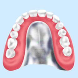 【金属床義歯】歯茎に触れる箇所に金属を用いた入れ歯